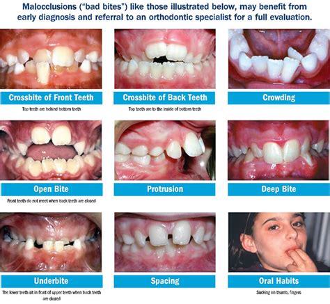 1 month braces transformation|Different Phases of Braces Treatment .